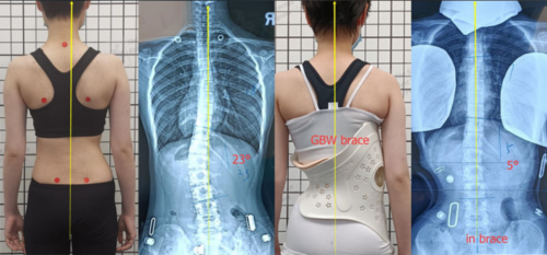 هل يمكن الشفاء من اعوجاج العمود الفقري بدون جراحة؟
