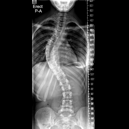 هل شد الأعصاب هو سبب اعوجاج العمود الفقري؟