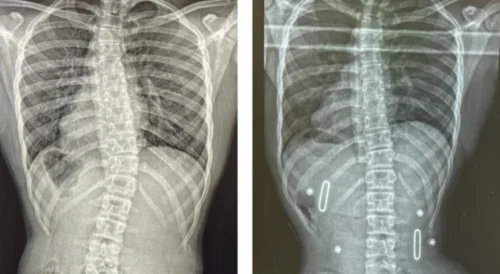 استخدام حزام اعوجاج العمود الفقري