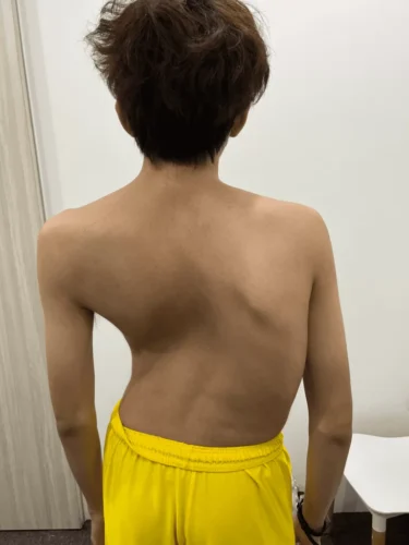 احتمالية تطور اعوجاج العمود الفقري البسيط