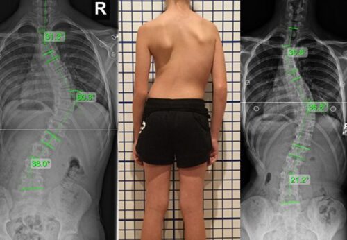 ماذا يحدث إذا لم يتم استخدام حزام اعوجاج العمود الفقري عند الحاجة؟
