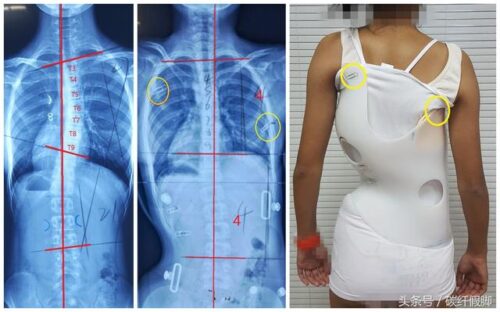 ما هو حزام اعوجاج العمود الفقري؟