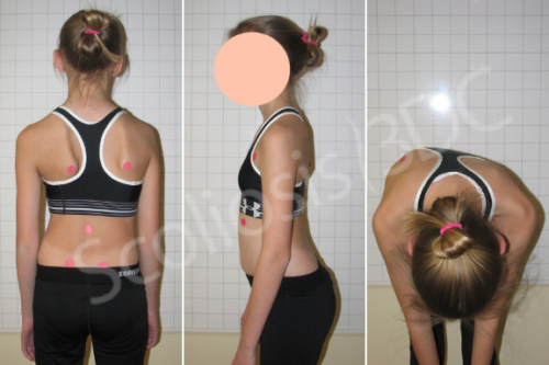 اعوجاج العمود الفقري (Scoliosis)؟