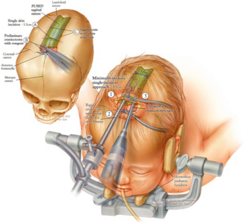 ما هو علاج تعظّم الدروز الباكر؟