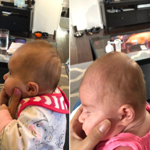 متى يجب بدء خوذة علاج تسطح الرأس عند الأطفال؟