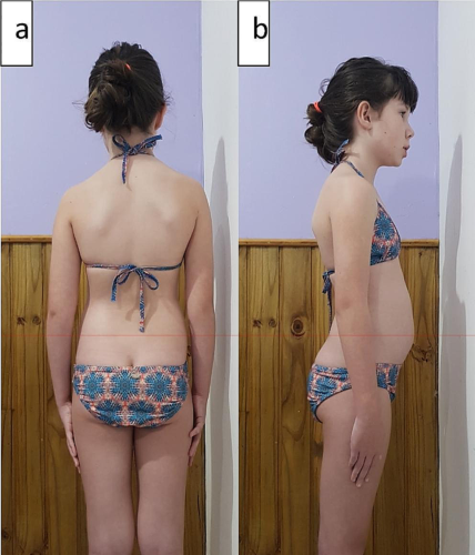 ماذا يحدث داخل الجسم مع اعوجاج العمود الفقري؟