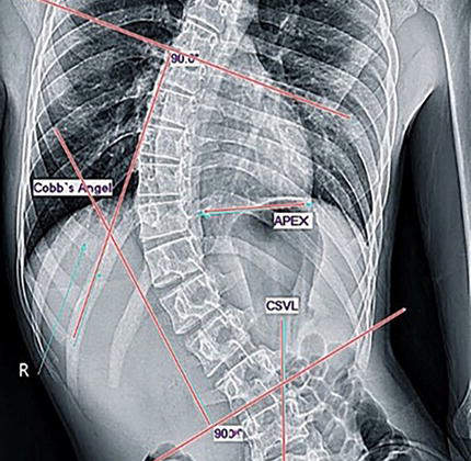 ما العلاقة بين التليّف العظمي الليفي والجنف؟