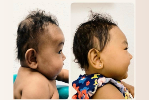 ما هي خوذة علاج تسطح الرأس عند الأطفال؟