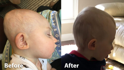 هل خوذة علاج تسطح الرأس فعالة فعلاً؟