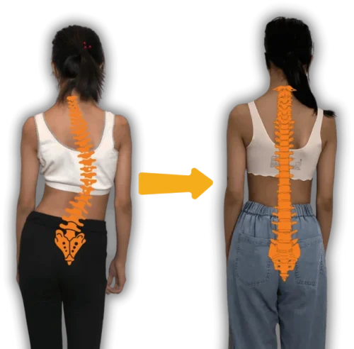 اعوجاج العمود الفقري