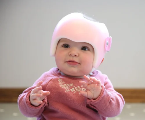 ماذا أفعل إذا ظهرت مضاعفات مع خوذة علاج تسطح الرأس؟