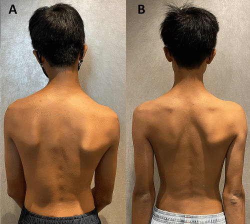 المتابعة المبكرة لاعوجاج العمود الفقري