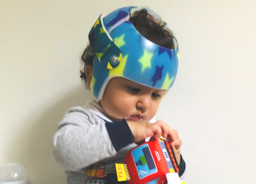 لماذا يحتاج الطفل خوذة طبية بعد جراحة التحام عظام الجمجمة بالمنظار؟