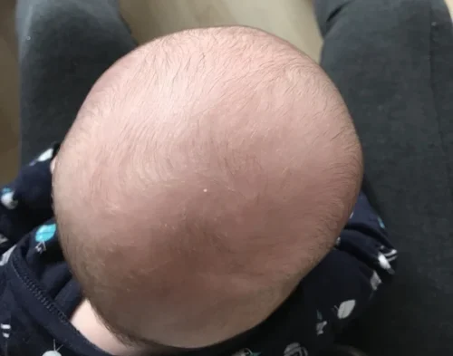 علاج تسطح الرأس حسب عمر الطفل