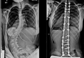 هل تحسّن جراحة اعوجاج العمود الفقري العصبي العضلي جودة الحياة؟ وما النتائج المتوقعة عند الأطفال؟