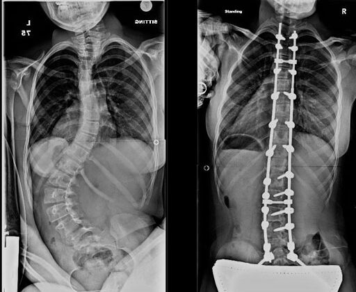 هل تحسّن جراحة اعوجاج العمود الفقري العصبي العضلي جودة الحياة؟ وما النتائج المتوقعة عند الأطفال؟