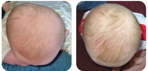 علاج تسطح الرأس