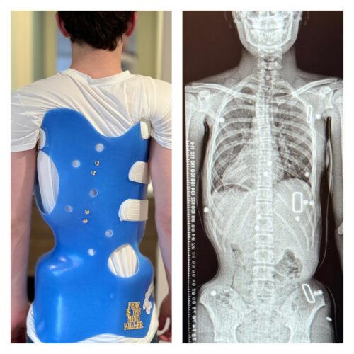 ما الفرق بين الأشعة داخل حزام اعوجاج العمود الفقري وخارجه؟