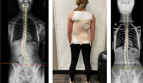 هل حزام اعوجاج العمود الفقري يضغط نفسيًا على طفلك؟