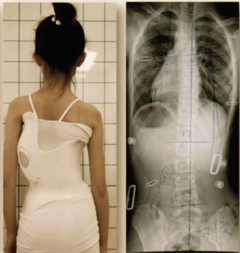 هل يمكن أن يتحسن الاعوجاج؟