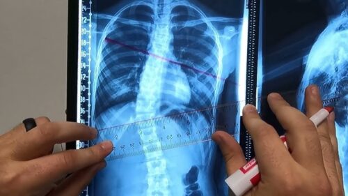 هل يمكن تجنب جراحة اعوجاج العمود الفقري بالعلاج الطبيعي؟