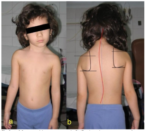 لماذا يؤجل بعض الأهالي استخدام حزام اعوجاج العمود الفقري؟ وما العواقب المحتملة؟