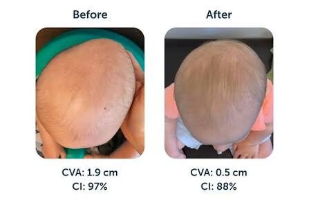 ماذا يحدث في حالات عدم تماثل الرأس (Plagiocephaly)؟
