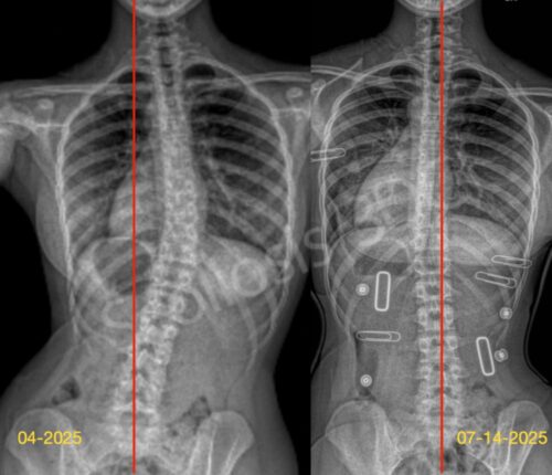 حزام اعوجاج العمود الفقري PioBrace