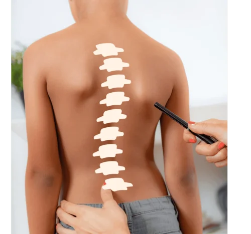 هل يمكن علاج الحداب واعوجاج العمود الفقري في الوقت نفسه؟